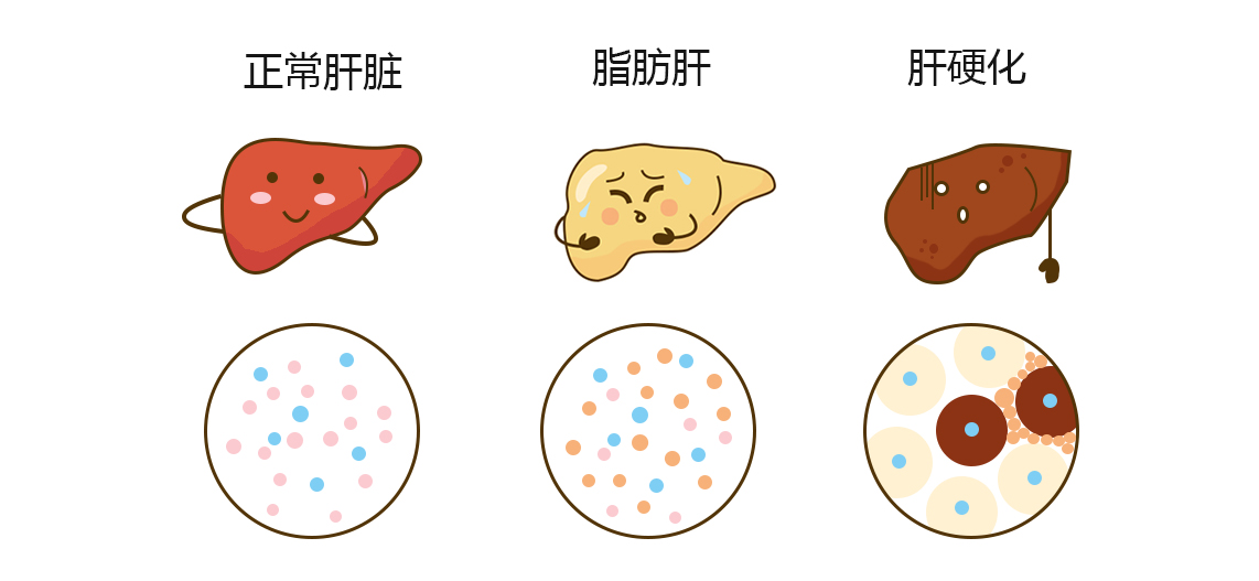 脂肪肝进程.jpg